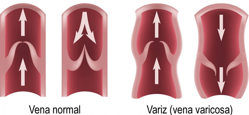 Varius; vena normal i vena varicosa